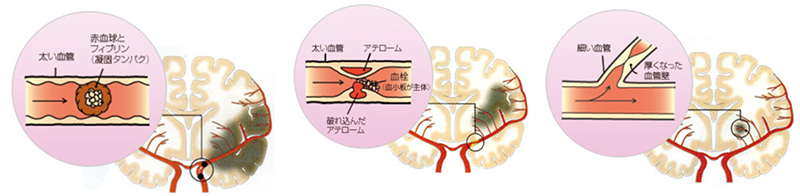 一次脳卒中センター画像3
